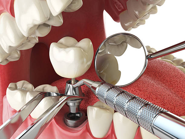 Best Emergency Dentist for Knocked-Out Tooth in Homeland, GA